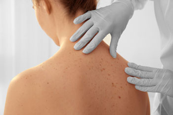 Picture of a Dermatologist wearing gloves while putting their hands on the back of a females upper back and shoulder.
